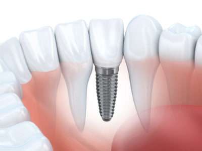 Dents manquantes implant dentaire Barberaz
