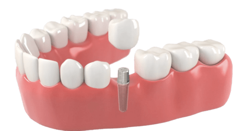 Implants dentaire cabinet dentiste des Savoies