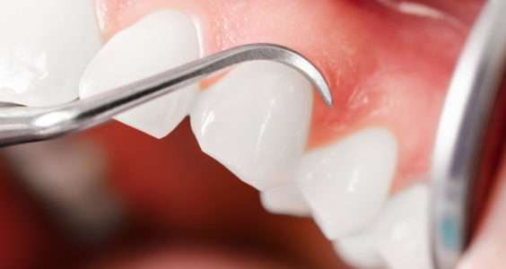 Intervention soin gencives cabinet dentaires des Savoie