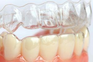 goutiières haut bas goutiières haut bas